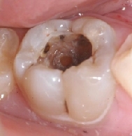 急な歯ぐきの腫れ・痛み