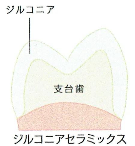 フルジルコニア