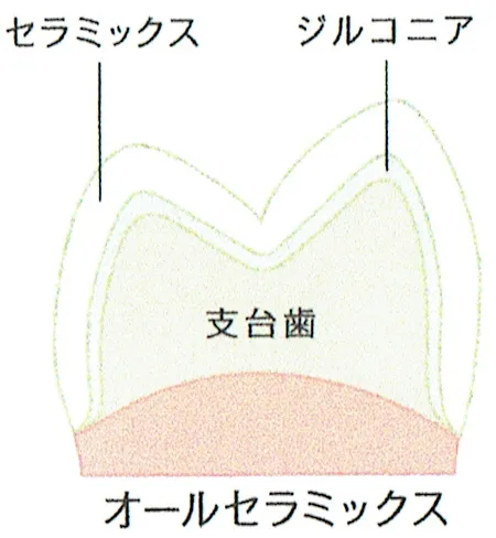 ポーセレンジルコニア(セラミックジルコニア)